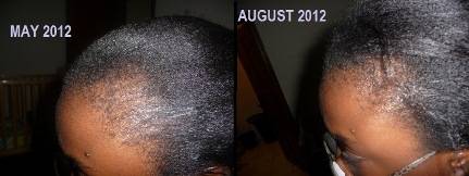 left side hairline BEFORE AND AFTER small
