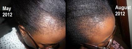 right side hairline before and after smaller size