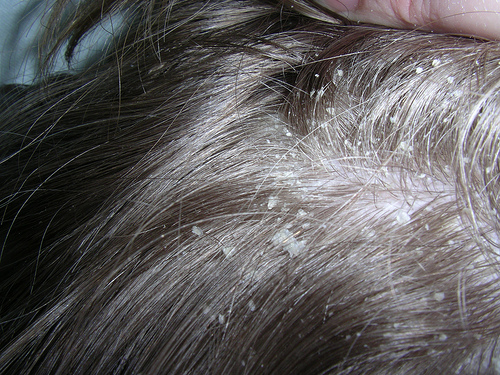 Dandruff Images & Stock Pictures. Royalty Free Dandruff ...